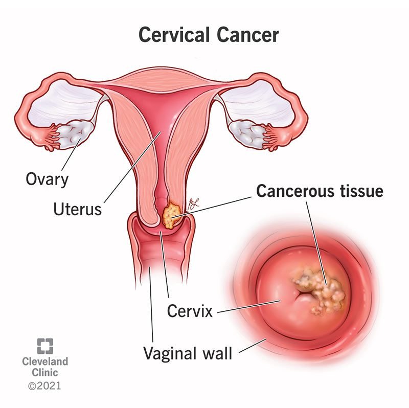 
cervical-cancer-the-clutter.