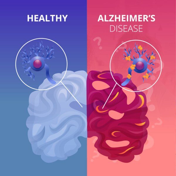 Alzheimer-disease-the clutter