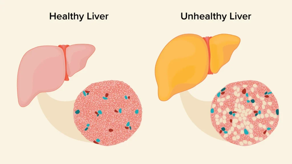 Fatty liver-the clutter