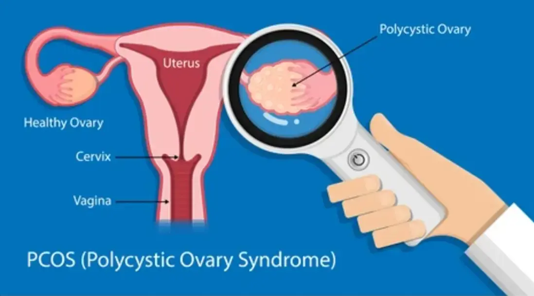 pcos-the clutter