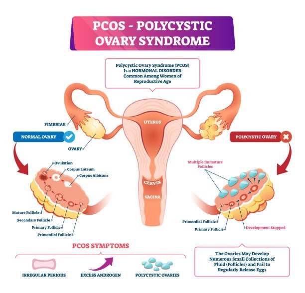 pcos sings-the clutter